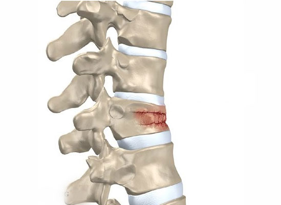 Spinal Fracture