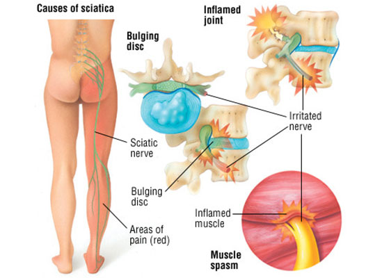 Sciatica